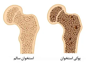 انجام تمرینات انفجاری؛ راهکاری مناسب برای پیشگیری از پوکی استخوان
