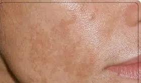دلیل ایجاد لک های پوستی چیست؟