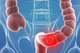 اینفوگرافی | علائم سرطان روده