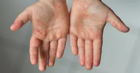 درباره سرخک و واکسیناسیون آن، چه می&zwnj;دانید؟
