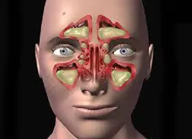 آلودگی هوا چگونه موجب تشدید سینوزیت مزمن می&zwnj;شود؟