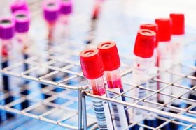 دانشمندان موفق به حذف ویروس HIV از سلول های آلوده شده&zwnj;اند