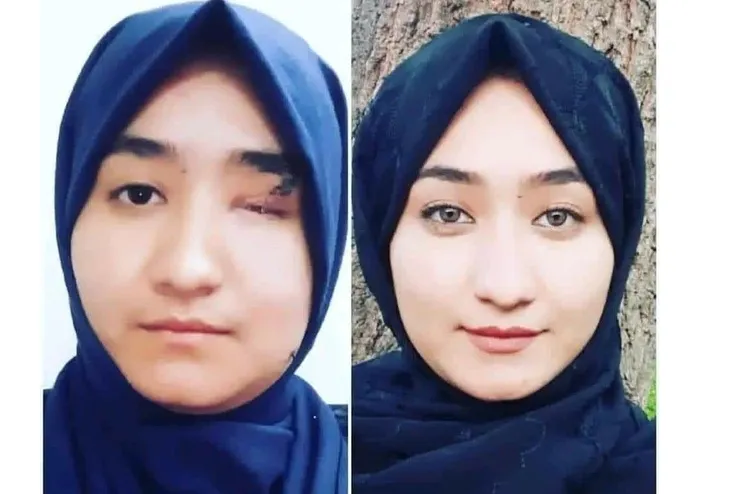 فاطمه از زخمی‌های حمله داعش بر مرکز آموزشی کاج در دانشگاه کابل قبول شد