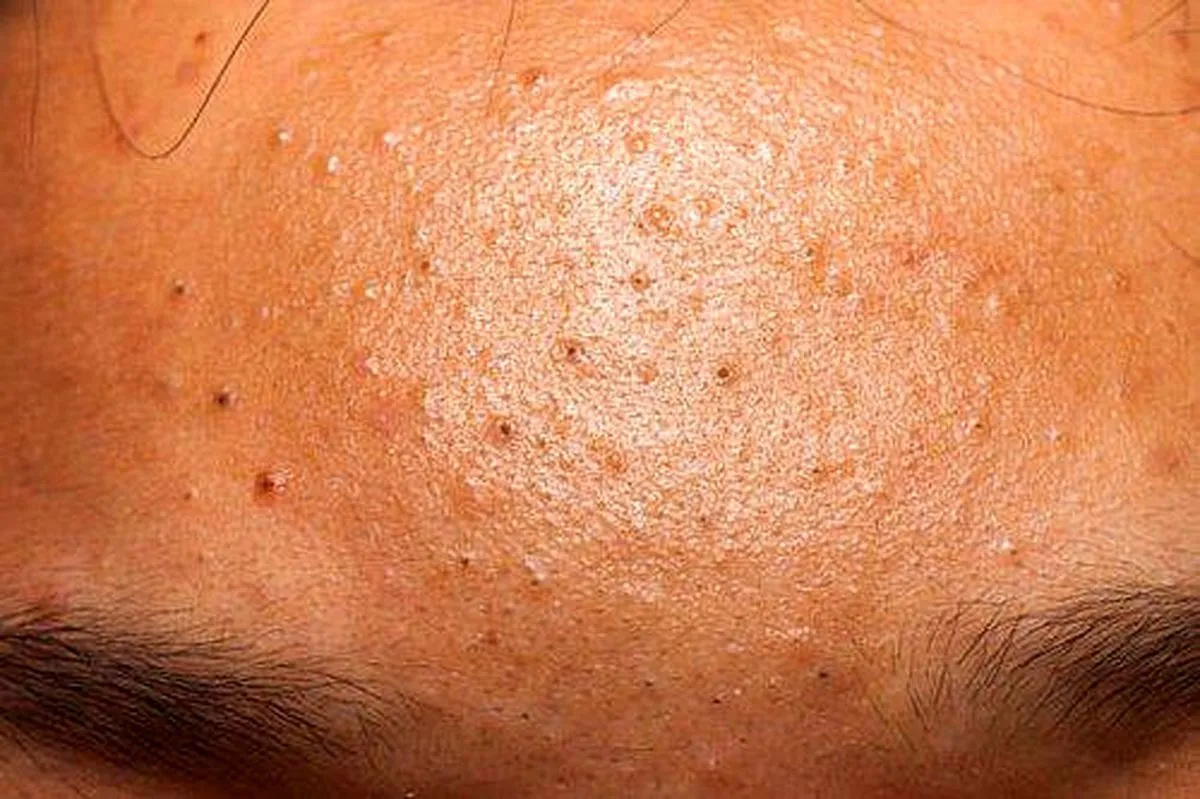 اینفوگرافی| چگونه از شر جوش‌های سر سیاه خلاص شویم؟