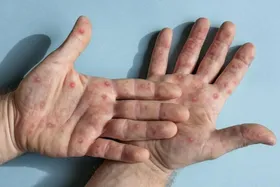 آبله میمونی چه تفاوت&zwnj;هایی با کرونا دارد؟