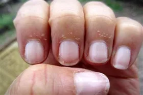 با علل ریش ریش شدن گوشه&zwnj;های ناخن آشنا شوید