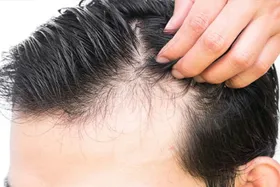 این غذا&zwnj;ها را نخورید تا ریزش مو نگیرید