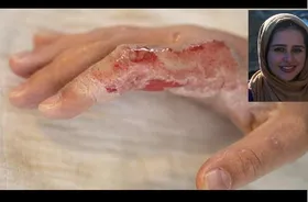 نتیجه یک پژوهش از امکان درمان سوختگی&zwnj;های شدید خبر می&zwnj;دهد