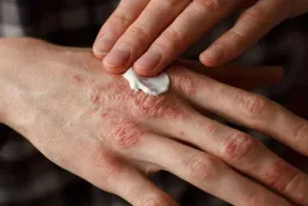 از علائم بیماری پسوریازیس چه می&zwnj;دانید؟