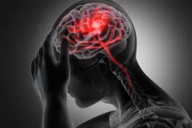 سکته مغزی، دومین علت مرگ در ایرانی&zwnj;ها