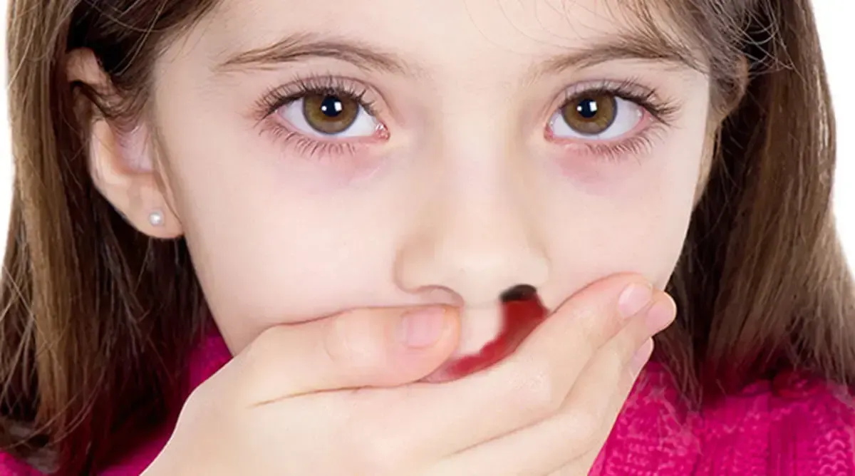 علت خون‌دماغ چیست؟ | شایع‌ترین علل خونریزی بینی 